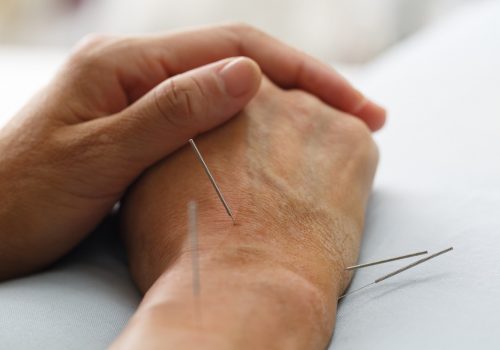 The patient had a lot of acupuncture on his hand